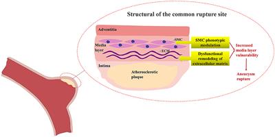 Identification of co-expressed central genes and transcription factors in atherosclerosis-related intracranial aneurysm
